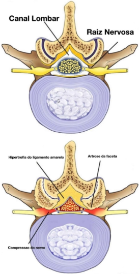 M Dico Lucas Ortopedia E Traumatologia Estenose